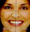 Teeth Whitening - Rembrandt Teeth Whitening